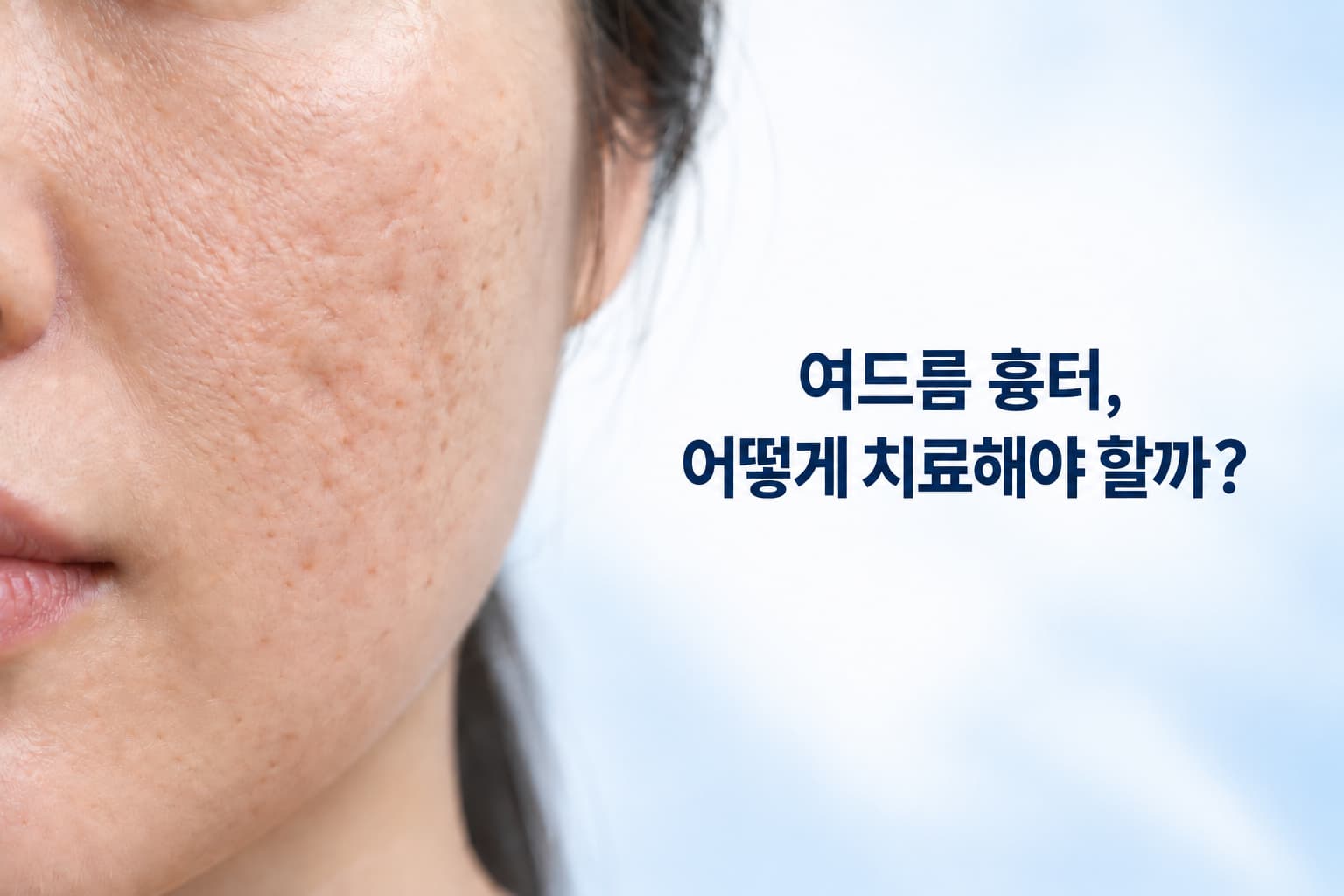 여드름 흉터 제거 시술_효과와 피부 상태별 치료 방법은