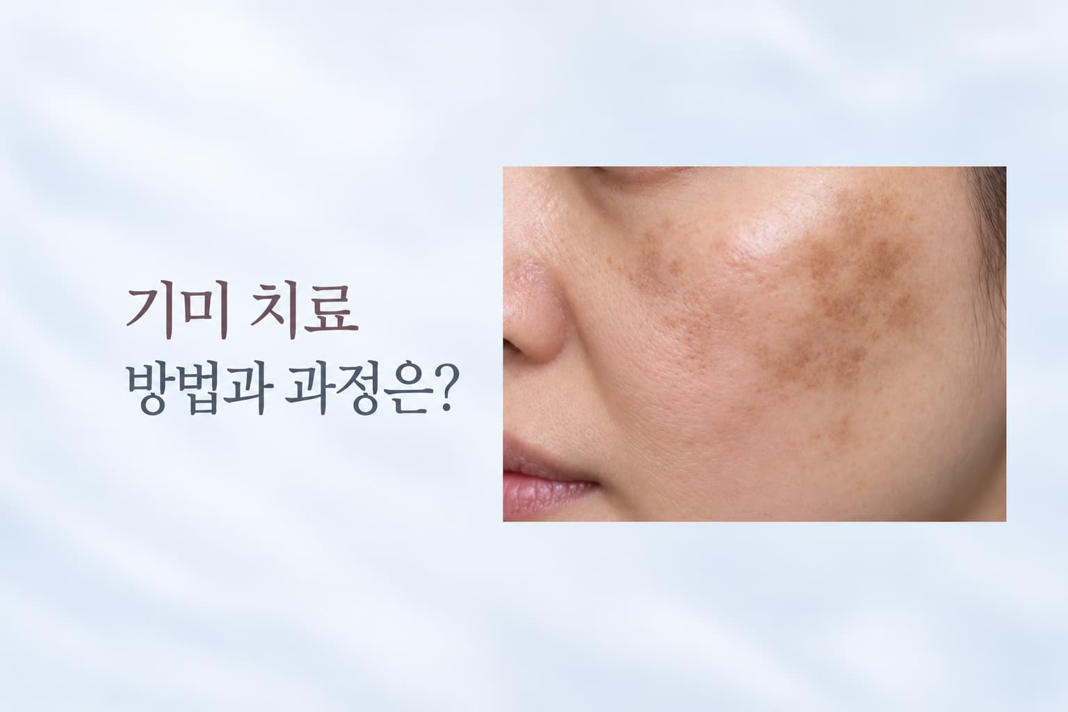 기미 없애는 방법은? 색소 구분부터 레이저 치료 과정까지