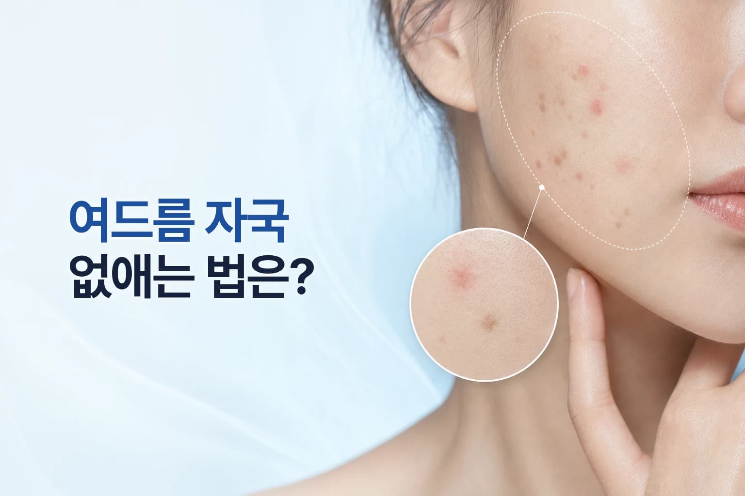 여드름 자국 없애는 법_자국 유형에 따른 치료 방법
